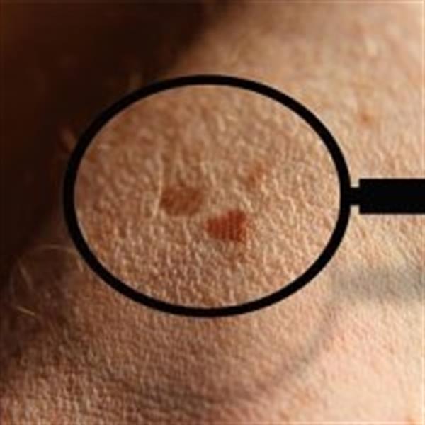 شایع ترین سرطان در ایران پوستی است